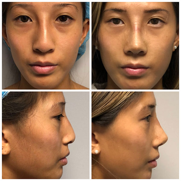 Asian Rhinoplasty before and after photos