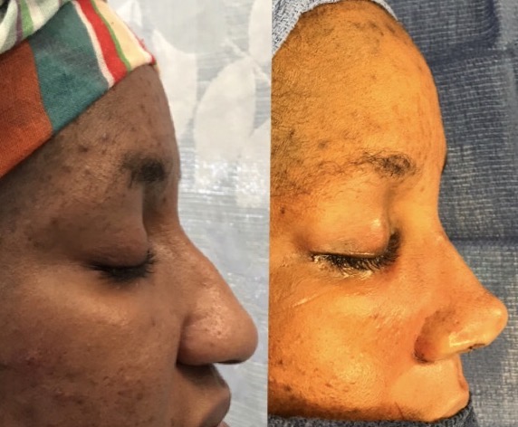 ethnic rhinoplasty before and after procedure