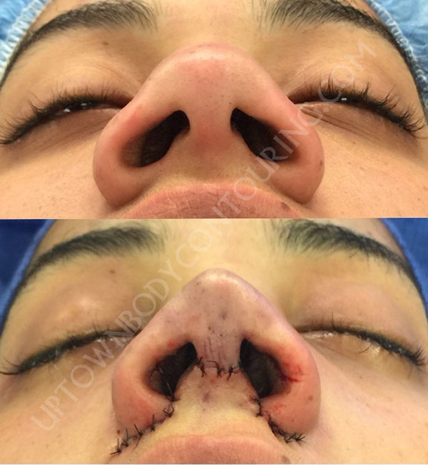 flaring wide nostrils before and after photo
