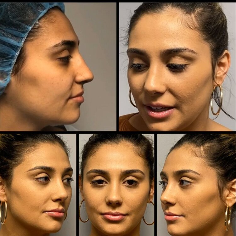 Before and after photo following rhiniplasty procedure