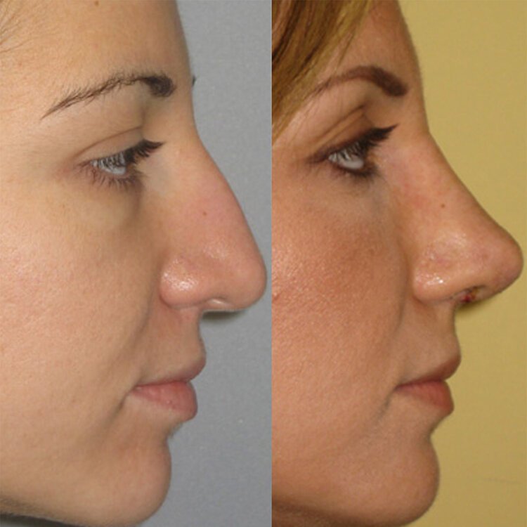 Before and After - Caucasian Rhinoplasty