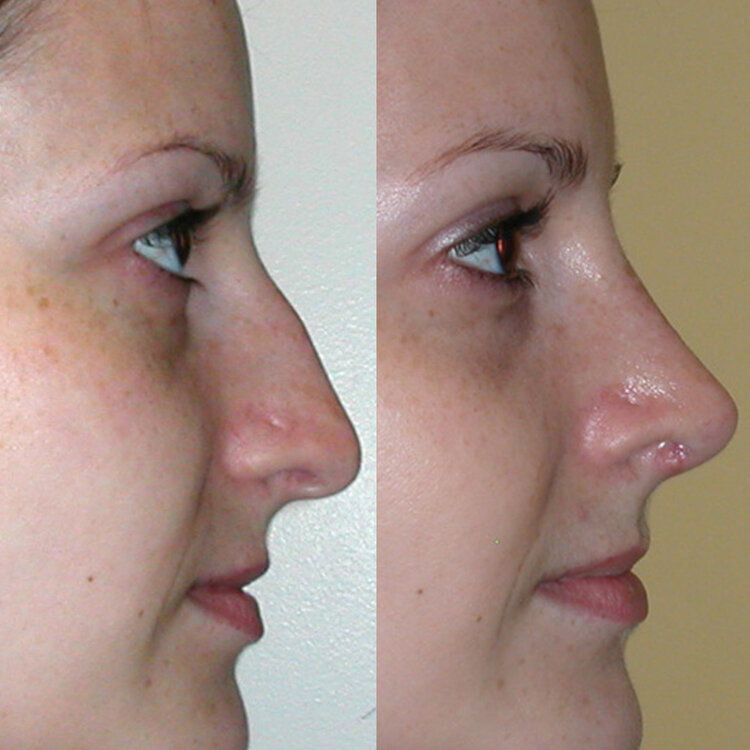 Before and After - Caucasian Rhinoplasty