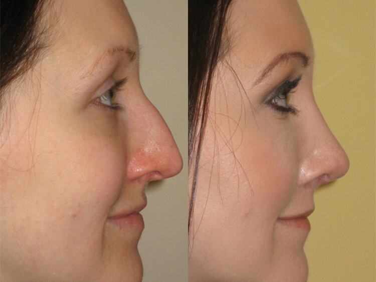 Before and After - Caucasian Rhinoplasty