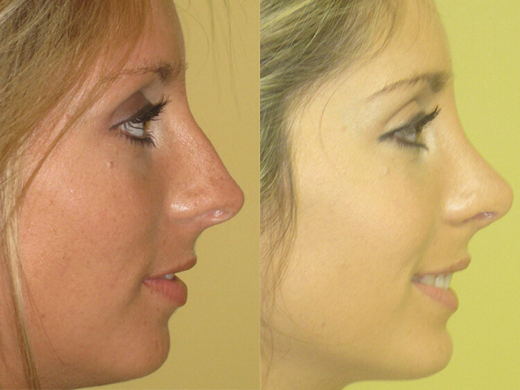 Before and After - Caucasian Rhinoplasty