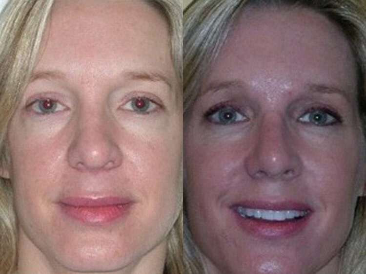 Before and after photo following rhiniplasty procedure