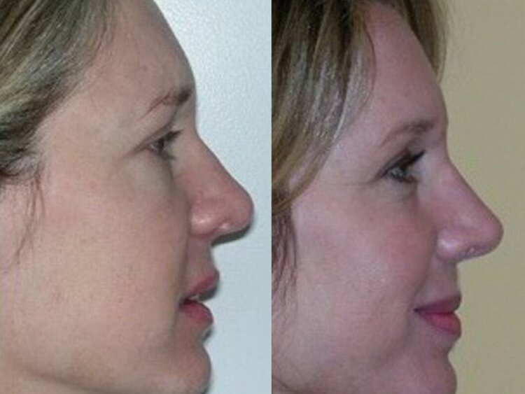 Before and after photo following rhiniplasty procedure
