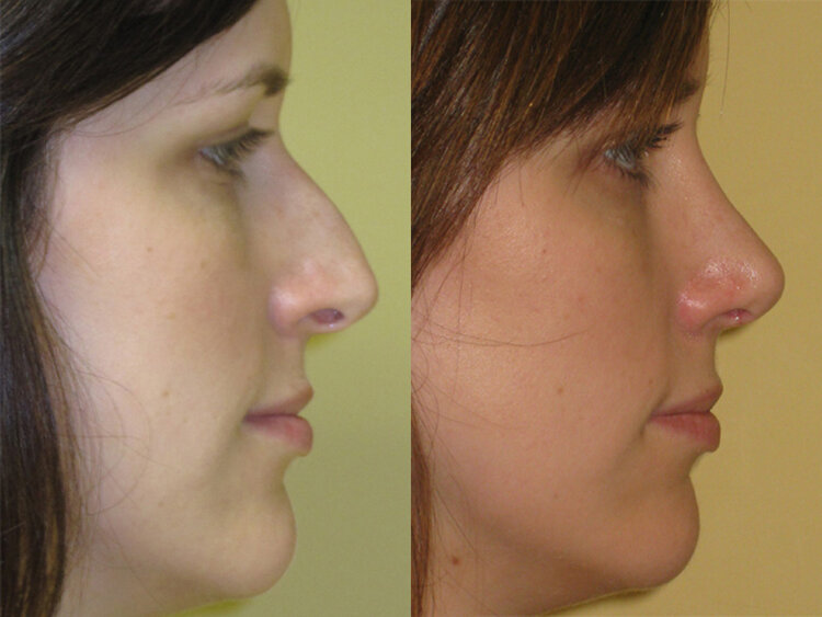 Before and after photo following rhiniplasty procedure
