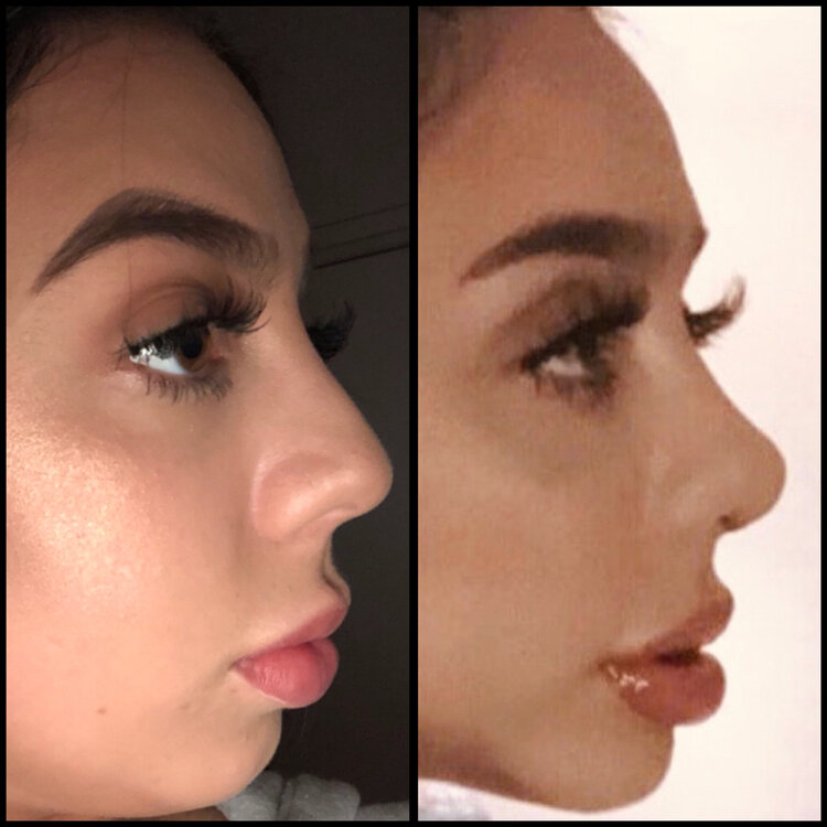 Before and After - Caucasian Rhinoplasty