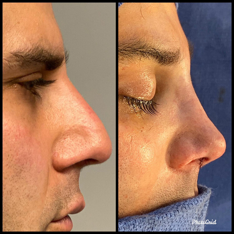 Before and After - Caucasian Rhinoplasty