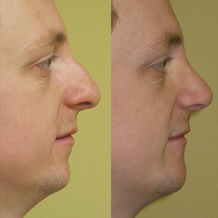 Before and After - Caucasian Rhinoplasty