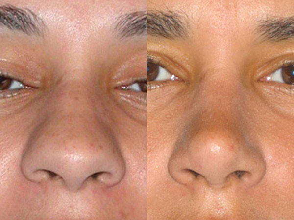 wide bridge before and after procedure