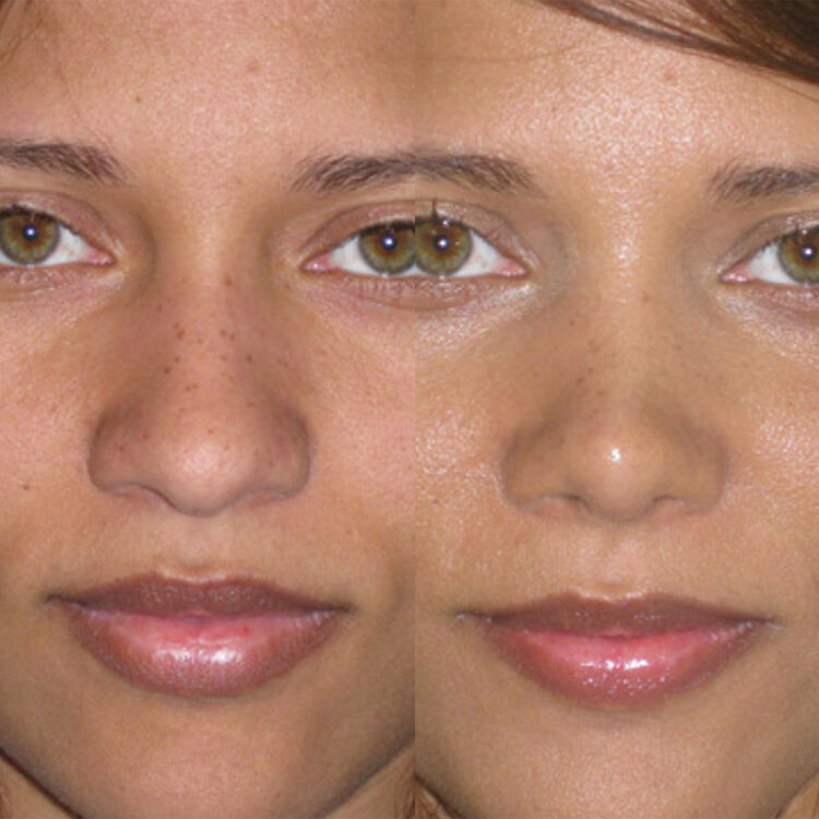 Before and After - Non Caucasian Rhinoplasty