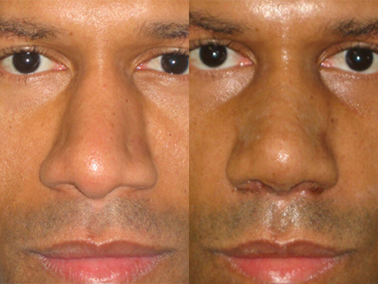 Before and After - Non Caucasian Rhinoplasty