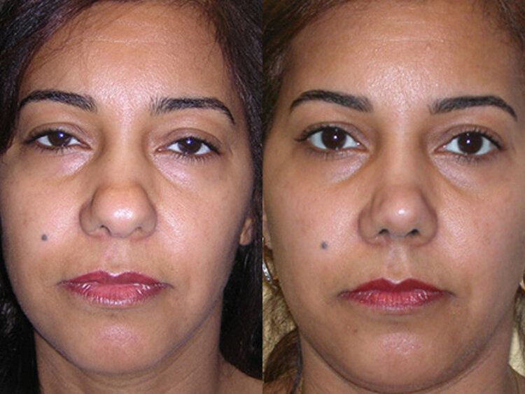 Before and After - Non Caucasian Rhinoplasty