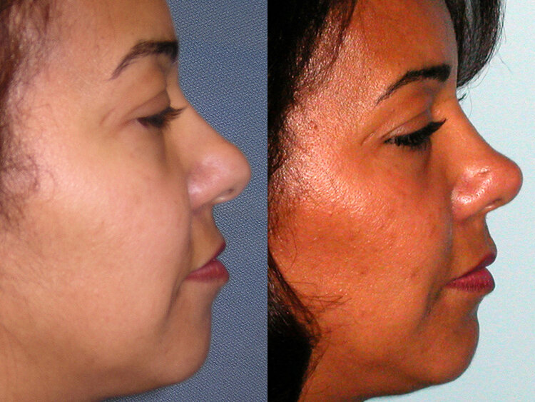 Before and After - Non Caucasian Rhinoplasty