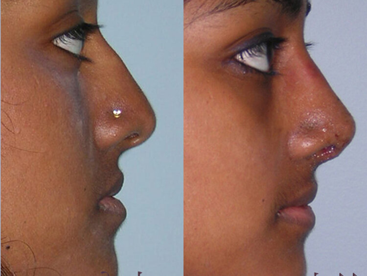 Before and After - Non Caucasian Rhinoplasty