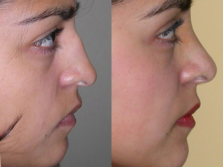 Before and After - Non Caucasian Rhinoplasty