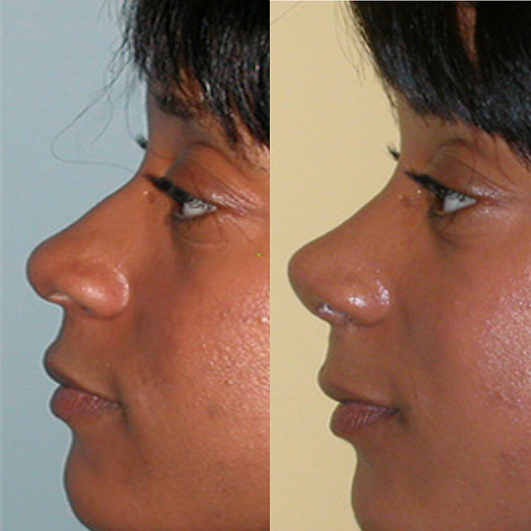 Before and After - Non Caucasian Rhinoplasty