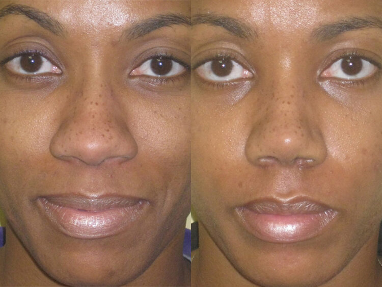 Before and After - Non Caucasian Rhinoplasty