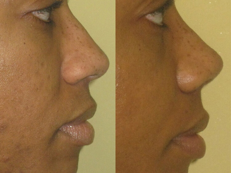 Before and After - Non Caucasian Rhinoplasty