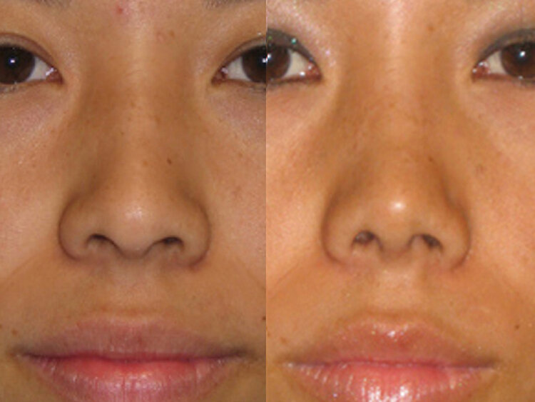 Before and After - Non Caucasian Rhinoplasty