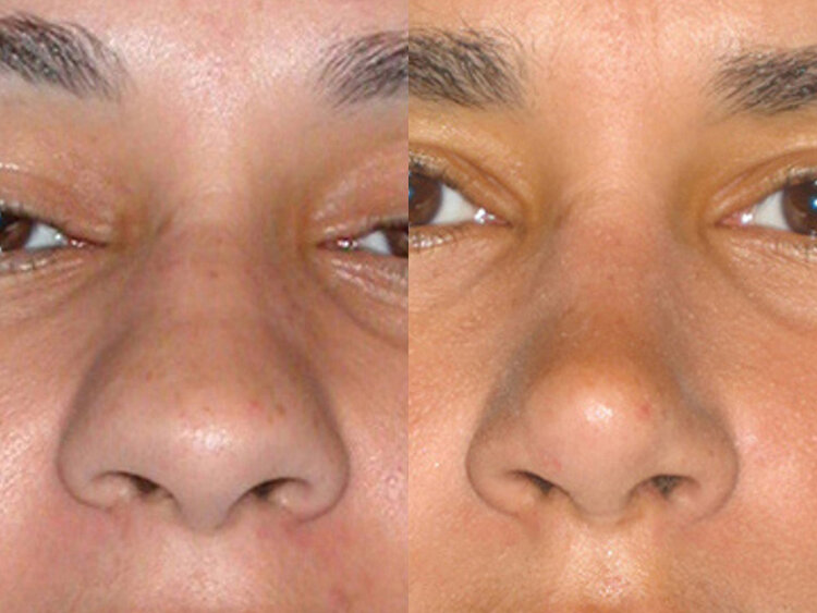 Before and After - Non Caucasian Rhinoplasty