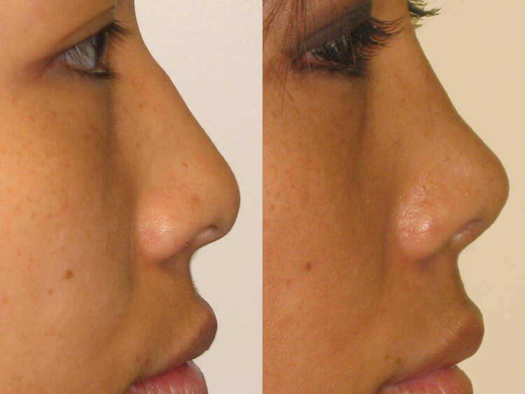 Before and After - Non Caucasian Rhinoplasty