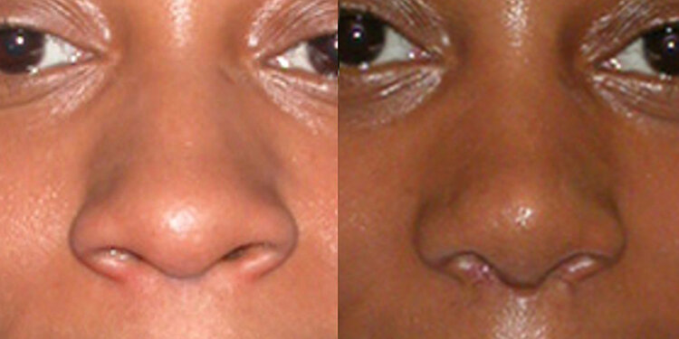 Before and After - Non Caucasian Rhinoplasty