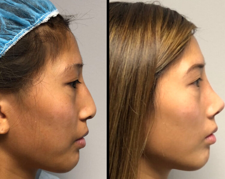 Before and After - Non Caucasian Rhinoplasty