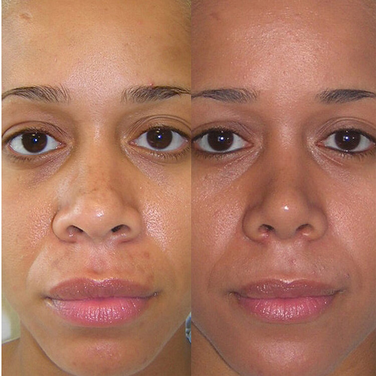 Before and After - Non Caucasian Rhinoplasty