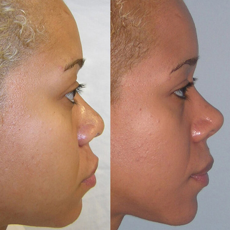 Before and After - Non Caucasian Rhinoplasty