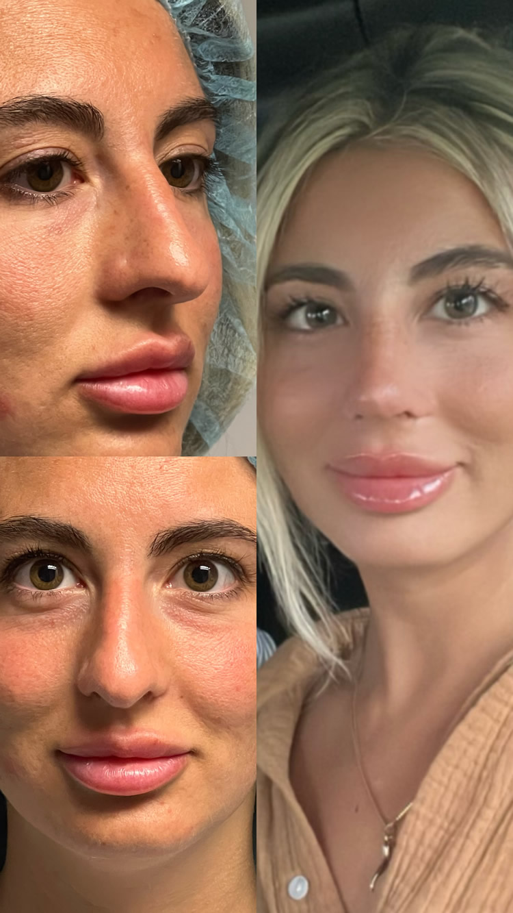 female patient before and after Rhinoplasty procedure
